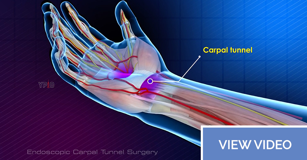 Endoscopic Carpal Tunnel Surgery