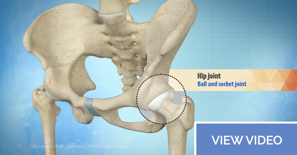 Ultrasound Guided Hip Injections