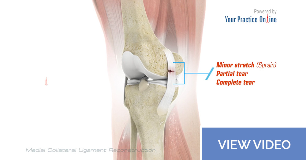 Medial Collateral Ligament Reconstruction