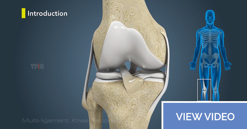 Multiligament Knee Reconstruction