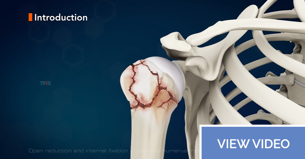 Open reduction and internal fixation of proximal humerus fracture