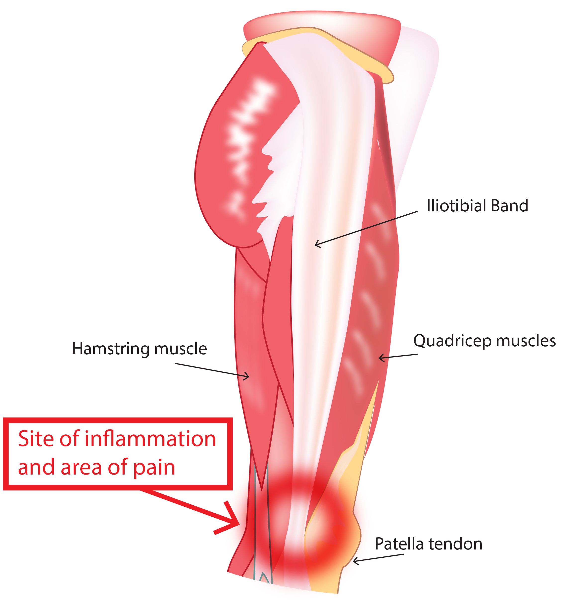 IT band Friction Syndrome – Ortho Rhode Island