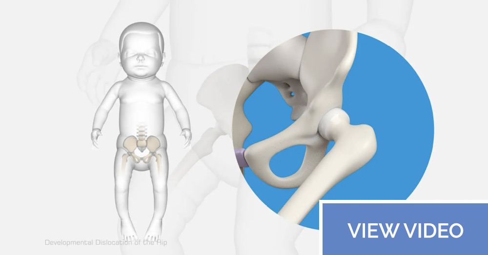 Developmental Dislocation of the Hip